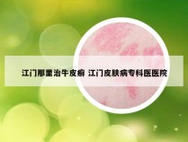 江门那里治牛皮癣 江门皮肤病专科医医院