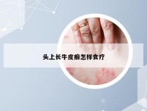 头上长牛皮癣怎样食疗