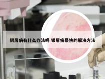 银屑病有什么办法吗 银屑病最快的解决方法