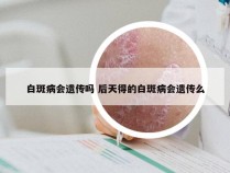 白斑病会遗传吗 后天得的白斑病会遗传么