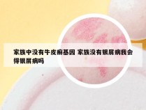 家族中没有牛皮癣基因 家族没有银屑病我会得银屑病吗
