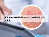 牛皮癣一停药就加重怎么办 牛皮癣停药就会复发么