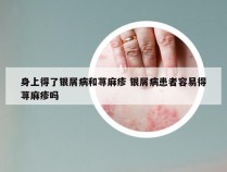 身上得了银屑病和荨麻疹 银屑病患者容易得荨麻疹吗
