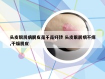 头皮银屑病脱皮是不是好转 头皮银屑病不痒,干燥脱皮