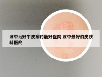 汉中治好牛皮癣的最好医院 汉中最好的皮肤科医院
