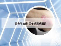 尿布牛皮癣 尿布银屑病图片