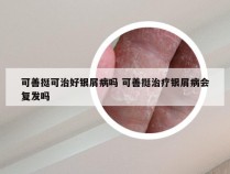 可善挺可治好银屑病吗 可善挺治疗银屑病会复发吗
