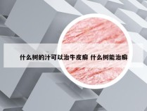 什么树的汁可以治牛皮癣 什么树能治癣