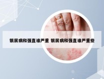 银屑病和强直谁严重 银屑病和强直谁严重些