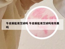 牛皮癣能用艾绒吗 牛皮癣能用艾绒吗有效果吗