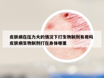 皮肤病在压力大的情况下打生物制剂有用吗 皮肤病生物制剂打在身体哪里
