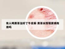 有人喝黑茶治好了牛皮癣 黑茶水擦银屑病有用吗