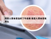 刑贵人草本膏治好了牛皮癣 邢贵人草本膏有用么