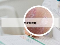 牛皮癣晚睡