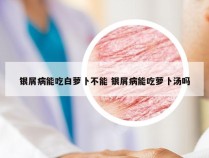 银屑病能吃白萝卜不能 银屑病能吃萝卜汤吗