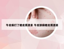 牛皮癣打了糖皮质激素 牛皮肤癣糖皮质激素