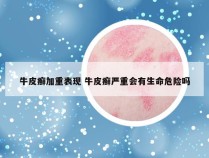 牛皮癣加重表现 牛皮癣严重会有生命危险吗