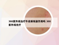 308紫外线治疗牛皮癣有副作用吗 308紫外线光疗