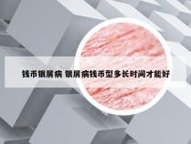 钱币银屑病 银屑病钱币型多长时间才能好