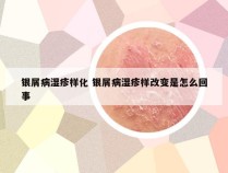 银屑病湿疹样化 银屑病湿疹样改变是怎么回事