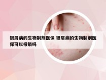 银屑病的生物制剂医保 银屑病的生物制剂医保可以报销吗
