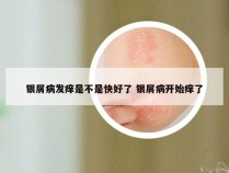 银屑病发痒是不是快好了 银屑病开始痒了