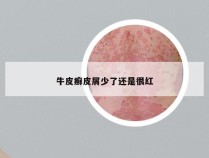 牛皮癣皮屑少了还是很红