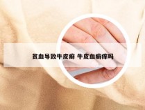 贫血导致牛皮癣 牛皮血癣痒吗