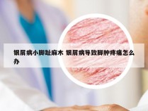 银屑病小脚趾麻木 银屑病导致脚肿疼痛怎么办