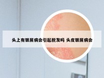 头上有银屑病会引起脱发吗 头皮银屑病会