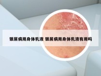 银屑病用身体乳液 银屑病用身体乳液有用吗