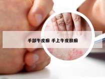 手部牛皮癣 手上牛皮肤癣