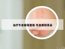 治疗牛皮癣耳割耳 牛皮癣划耳朵