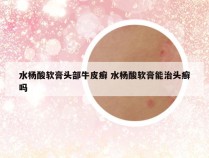 水杨酸软膏头部牛皮癣 水杨酸软膏能治头癣吗