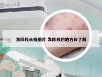 发际线长癣图片 发际线的地方长了藓