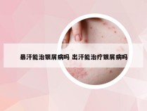 暴汗能治银屑病吗 出汗能治疗银屑病吗