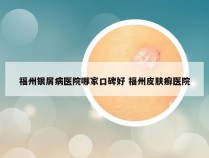 福州银屑病医院哪家口碑好 福州皮肤癣医院