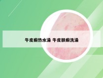 牛皮癣热水澡 牛皮肤癣洗澡