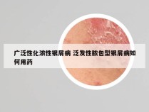 广泛性化浓性银屑病 泛发性脓包型银屑病如何用药