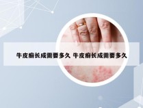 牛皮癣长成需要多久 牛皮癣长成需要多久
