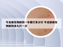 牛皮癣生物制剂一年要打多少针 牛皮肤癣生物制剂多久打一次