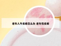 老年人牛皮癣怎么办 老年性皮癣