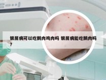 银屑病可以吃鹅肉鸡肉吗 银屑病能吃鹅肉吗?