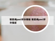 银屑病pasi评分模板 银屑病pasi评分描述