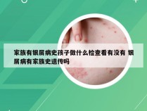 家族有银屑病史孩子做什么检查看有没有 银屑病有家族史遗传吗