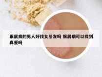 银屑病的男人好找女朋友吗 银屑病可以找到真爱吗