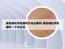 银屑病吃甲氨蝶呤片有必要吗 银屑病吃甲氨蝶呤一个月无效