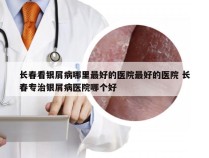 长春看银屑病哪里最好的医院最好的医院 长春专治银屑病医院哪个好