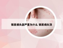 银屑病头部严重为什么 银屑病头顶