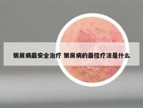 银屑病最安全治疗 银屑病的最佳疗法是什么